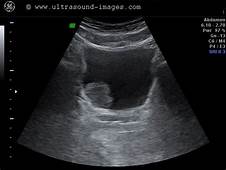 bladder